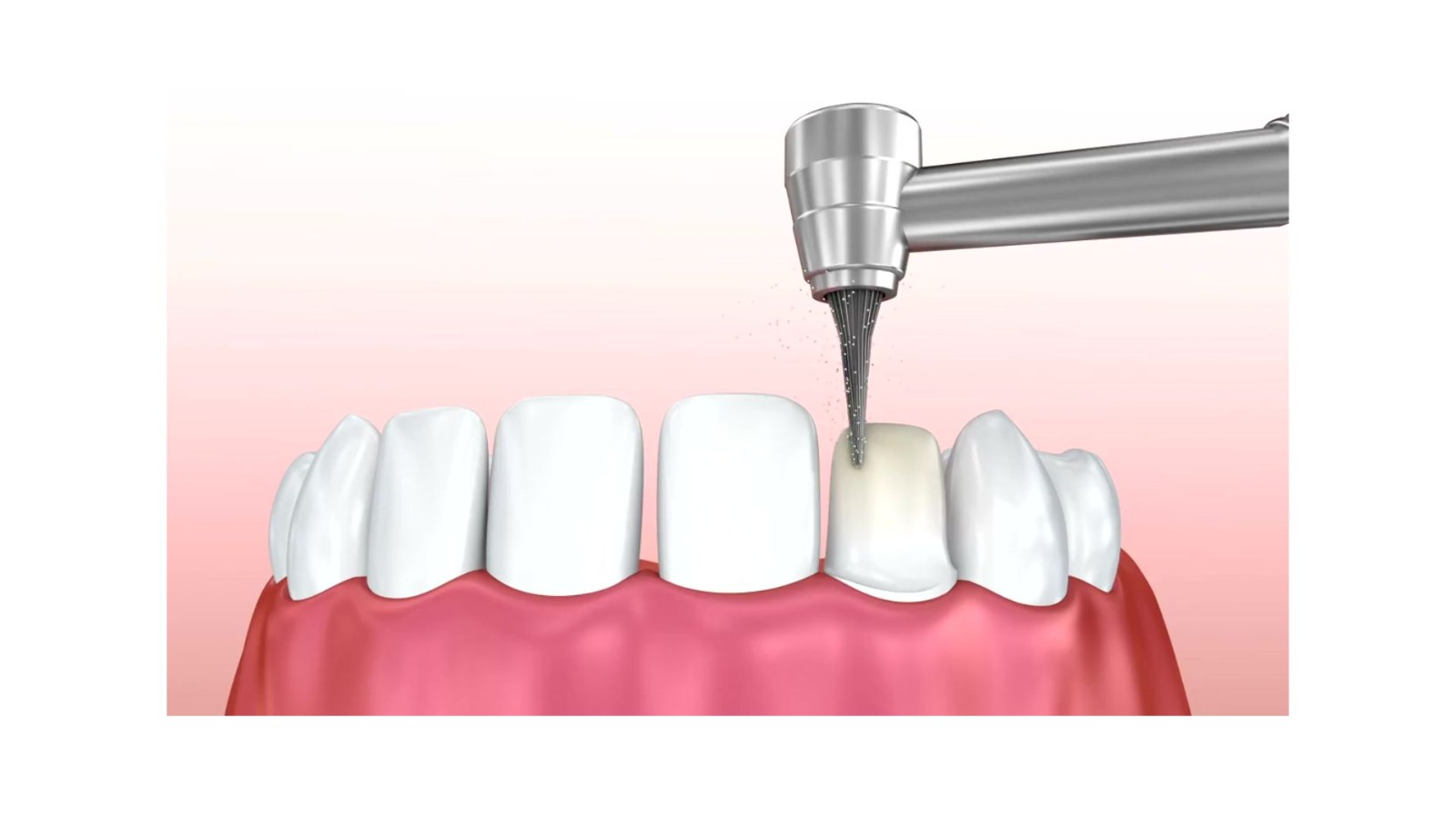 Aplicação de faceta dental