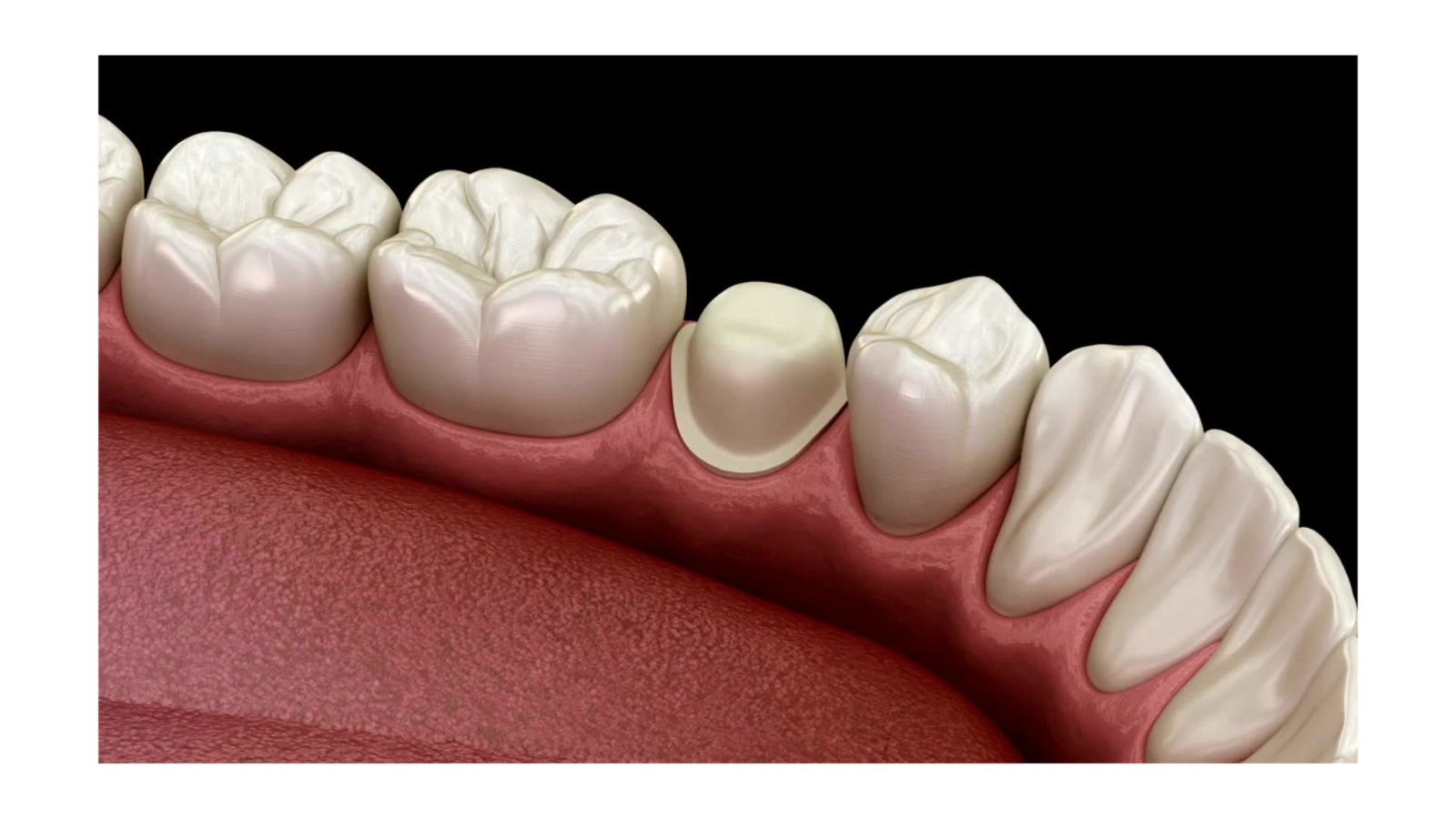 Preparo de dente para colocação de coroa após tratamento de canal