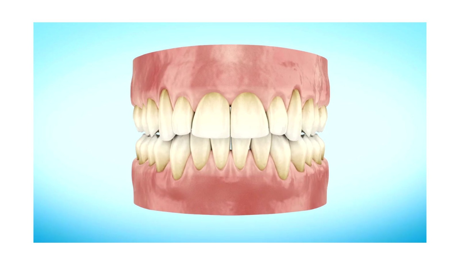 Tártaro e sinais de gengivite nos dentes