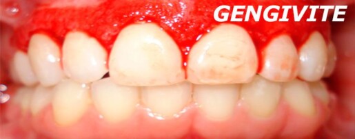 gengivite banner